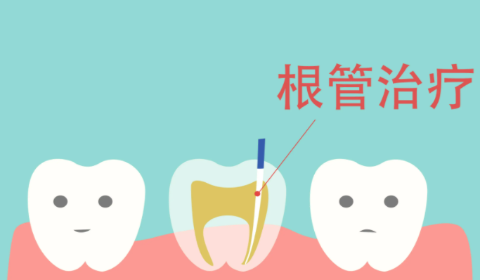 根管治療