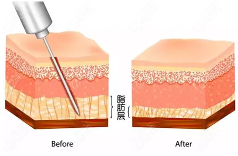 抽脂手術(shù)對(duì)身體有什么傷害？該不該禁止抽脂手術(shù)？